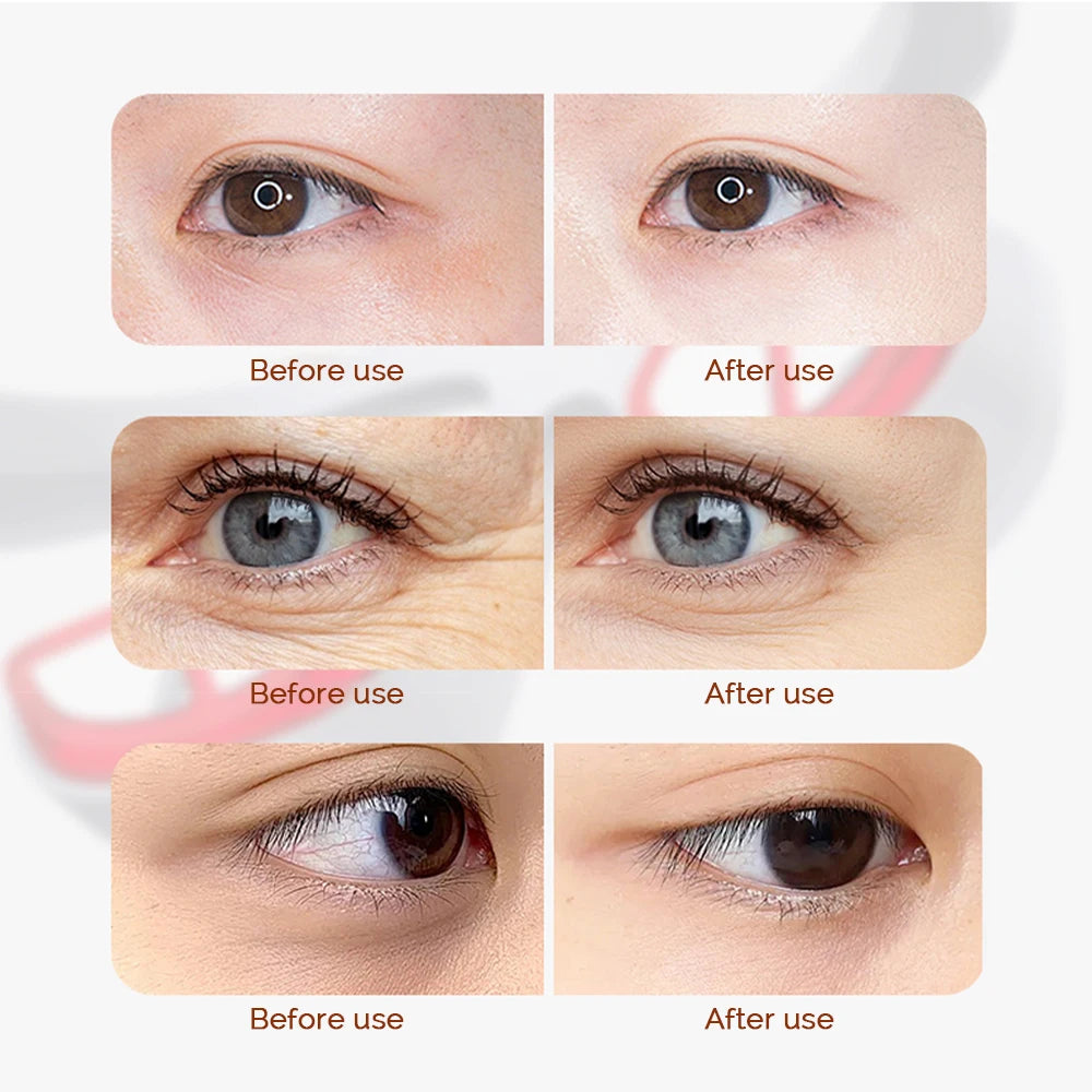 3D Eye Massager Device – Dark Circles & Wrinkle Care